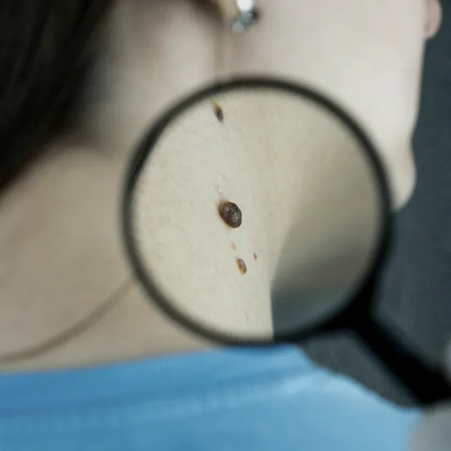 Imagen ilustrativa del área de Dermatología
